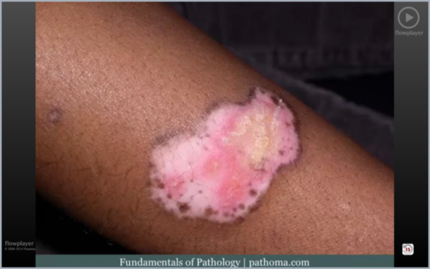 <p>ID the rash</p>