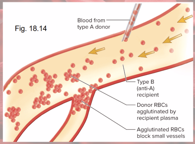 <p>agglutinated RBCs block small blood vessels and hemolyze</p><p>Hemoglobin blocks kidney tubules, causes renal failure</p>