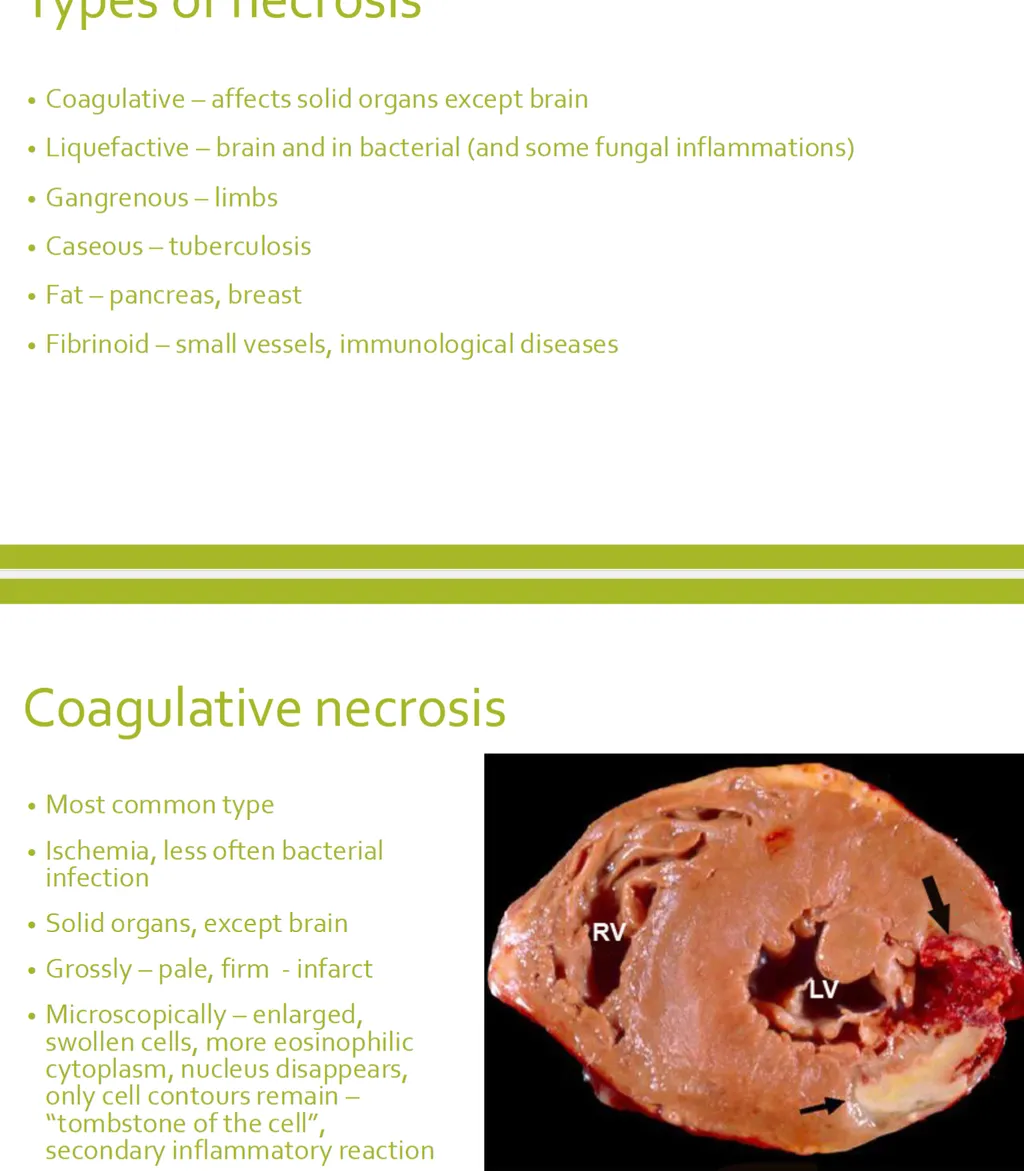 <p><strong><span>Indicate the correct statement(s) for coagulative necrosis. (2)</span></strong> </p><p><strong>a) it develops in organs composed mainly of proteins and containing less water and enzymes </strong></p><p><strong>b) “shadows” of previous structures can be seen microscopically </strong></p><p>c) it develops as a result of acute pancreatitis </p><p>d) there is total effacement of the previous structures microscopically</p>