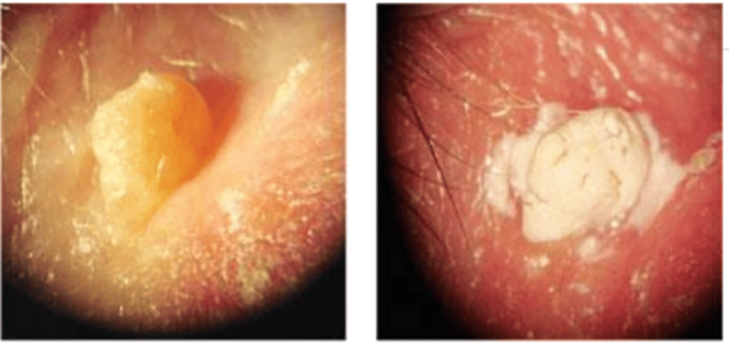 <p>proparacaine to reduce tearing from fumes</p><p>apply petroleum jelly to prevent compounding running to other areas</p><p>apply chemical on lesion with an applicator (may burn or sting slightly)</p><p>affected tissue turns white and may slough off to leave a small scab</p><p>apply abx/steroid ung to scab</p>