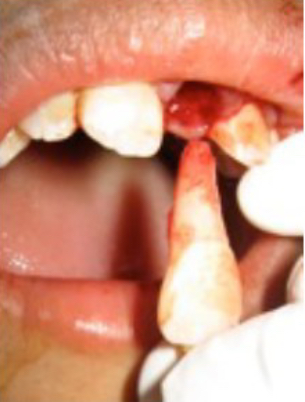 <p>Avulsion</p>