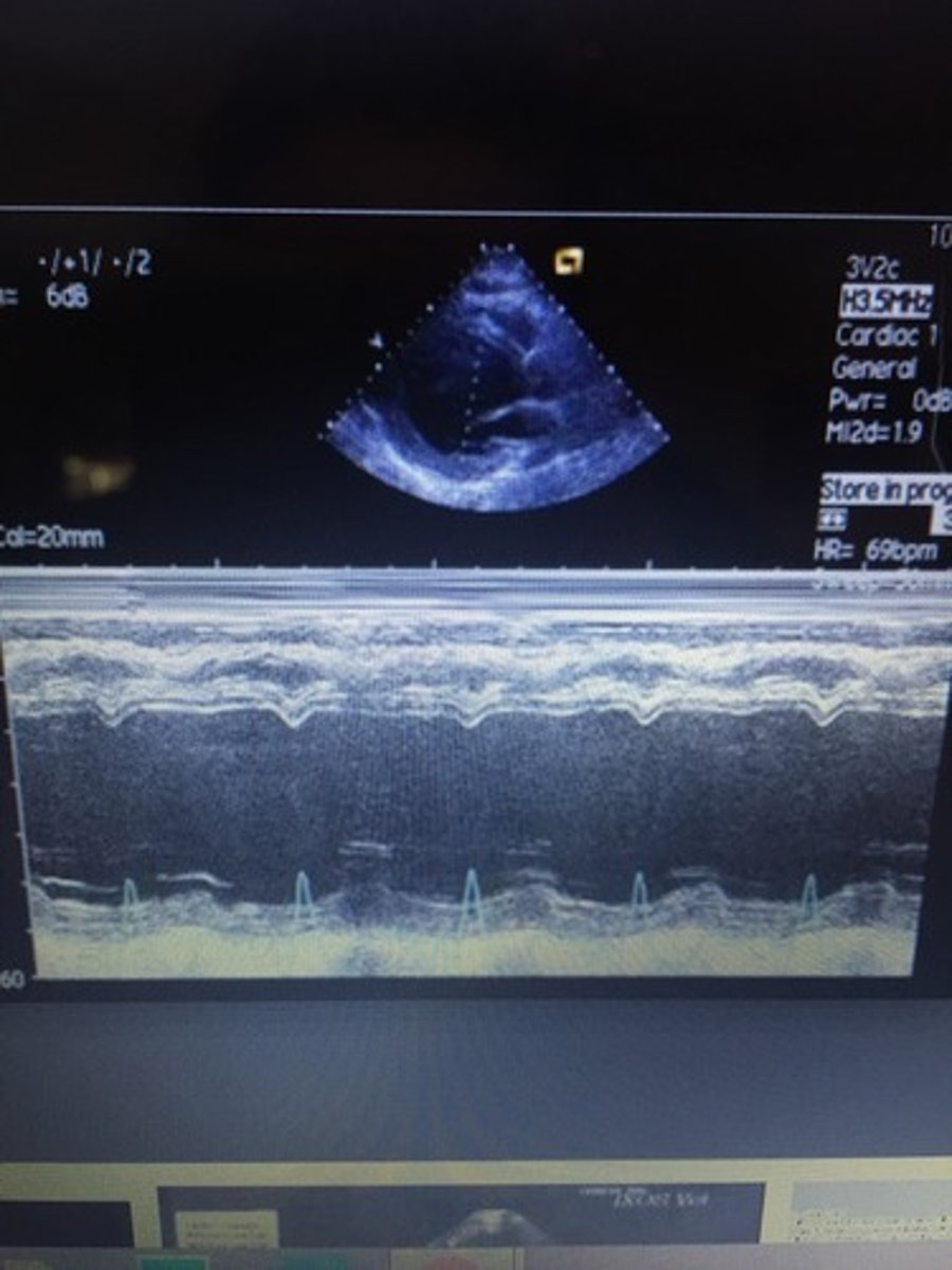 <p>LV dilation with poorly contracting septal or posterior walls; EPSS >10mm/s and decreased EF%; leads to congestive heart failure</p>