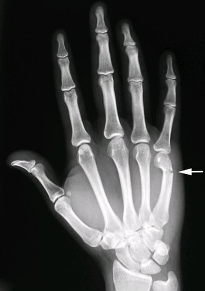 <p>fx of 5th metacarpal neck</p>