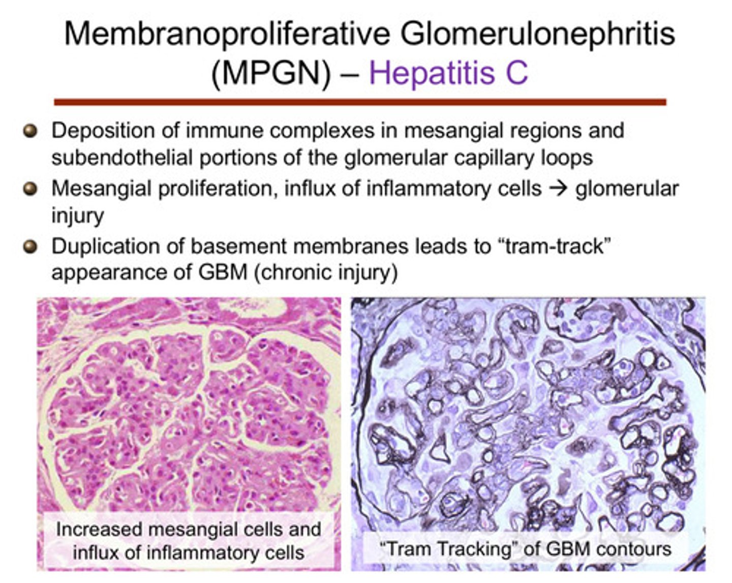 <p>1) deposition of immune complexes in mesangial region and subendothelial portions of the glomerular capillary loops</p><p>2) mesangial proliferation, influx of inflammatory cells —&gt; glomerular injury</p><p>3) duplication of basement membrane leads to a "tram-track" appearance of the glomerular basement membrane (chronic injury)</p>