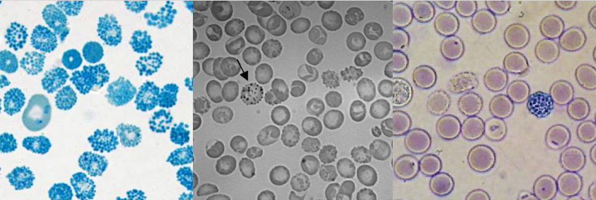 <p>A. Identify the cell<br>B. Identify the disease / condition<br>C. Composition of Inclusion</p>