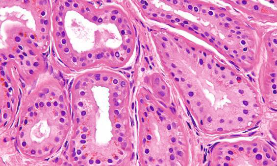 <p>Cerumen-gland adenoma</p><p>Composed of glands lined by 2 layers of cells;</p><p>-Inner luminal layer of cuboidal cells.</p><p>-Outer layer of myoepithelial cells.</p>