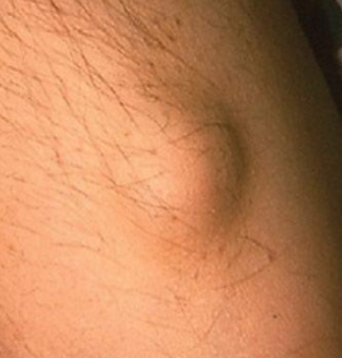 <p>a solid, raised lesion on the skin that is more than 1 centimeter in diameter. </p>
