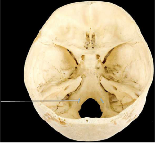 Which of the following cranial nerves is transmitted through the highlighted opening?