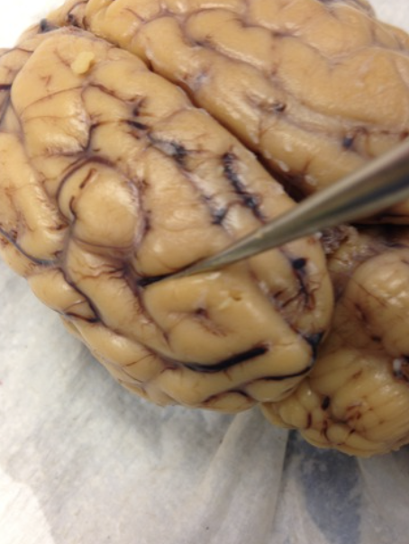 <p>a depression on the surface of the cerebrum </p>