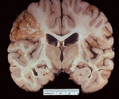 <p>ischemic injury to brain neurons; cells become digested by their own enzymes</p>