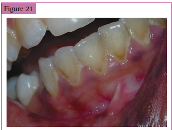 <p>Accumulation of calculus and food particles at the cervical margin of the tooth causing _____________________.</p>