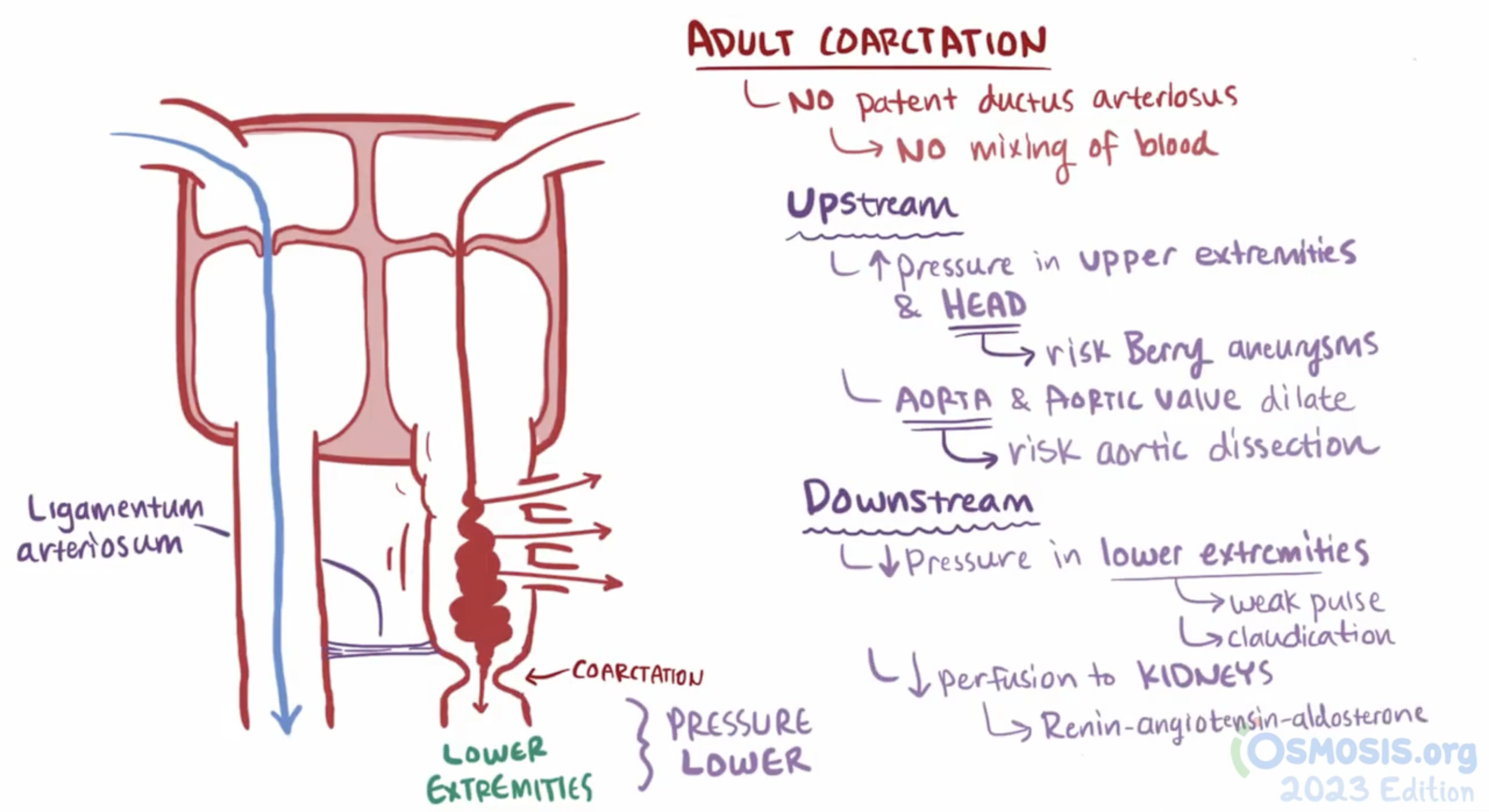 <p>narrowing of the aorta that occurs near the <strong>ligamentum arteriosum</strong> just distal to the origin of the <strong>left subclavian artery</strong></p><ul><li><p><strong>Infantile (pre-ductal):</strong> narrowing before the ductus arteriosus. Presents in infancy with heart failure</p><ul><li><p>radial-radial delay</p></li></ul></li><li><p><strong>Adult (post-ductal):</strong> narrowing after the ductus. Collateral circulation develops (via intercostal and internal mammary arteries)</p><ul><li><p>radial-femoral delay</p></li></ul></li></ul><img src="https://knowt-user-attachments.s3.amazonaws.com/c0ca97dc-492f-4fe3-8e78-2504a580de49.png" data-width="100%" data-align="center"><p></p>