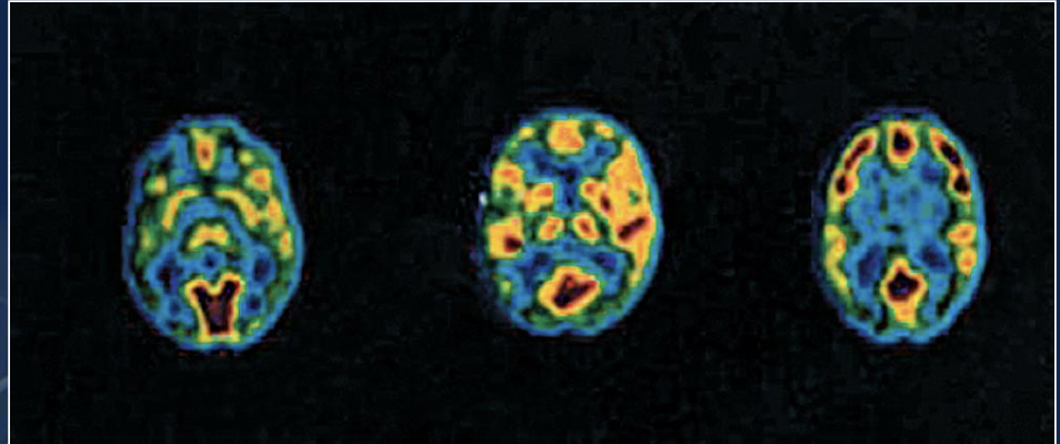 * Studying the relative activity of nervous system structures


* imaging technique that provides information regarding the localization of brain activity 
* measures brain activity based on the utilization of glucose or oxygen
  * data from gamma rays resulting from the breakdown of the racer are recorded by detectors and fed to a computer 
* pros: first technique to provide information about brain activity 
* cons: exposure to radioactive tracer; less resolution than other methods 
