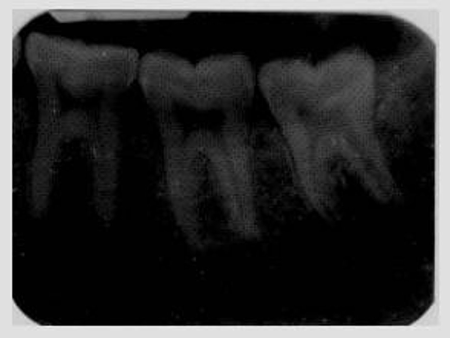 <p>film and digital appears dark or high in density</p><p>excess time, kilovoltage, or milliamperage</p>