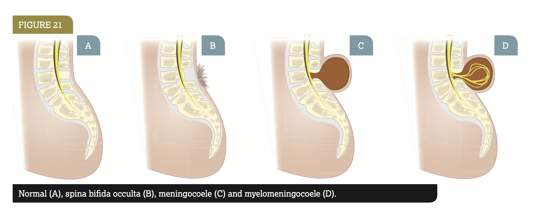 <ul><li><p>failure of midline fusion </p></li><li><p>dorsal vertebral bodies </p></li></ul>