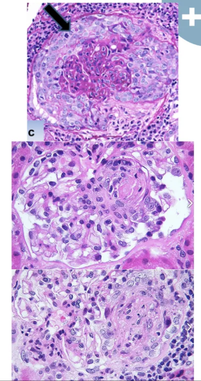 <p><strong>Nefritis lúpica focal de clase 3</strong></p><ul><li><p>Afectación con proliferación o cicatrización de<strong> </strong><span style="color: red;"><strong>menos del 50% de los glomérulos focal y segmentaria</strong></span></p></li><li><p>Puede haber lesiones segmentarias o globales</p></li><li><p>Glomérulos con proliferación endotelial y mesangial, con acumulación de leucocitos</p></li><li><p>Necrosis capilar y trombos hialinos</p></li><li><p>Proliferación extracapilar asociada a necrosis focal y formación de semilunas</p></li></ul><p></p><p>Presentación clínica:</p><ul><li><p>Hematuria y proteinuria leve</p></li><li><p>Sedimento urinario activo</p></li><li><p>Síndrome nefrótico</p></li><li><p>Hipertensión y GFR reducido</p></li></ul><p></p>