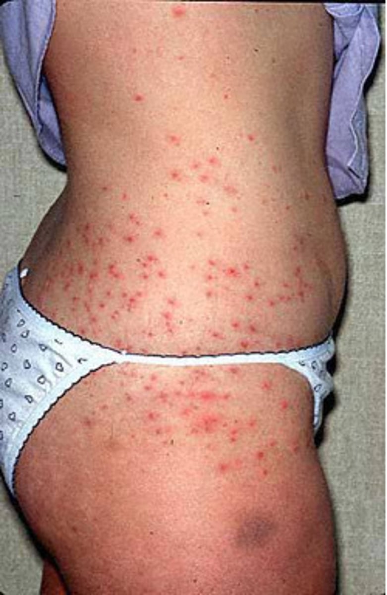 <p>CA: Pseudomonas aerginosa<br>MOT: -spread through contaminated hot tub/pool<br>Si/Sx: - red nodules -acne -pustules<br>Dx: -PE -Hx<br>Tx: -Silver sulfadiazine cream</p>