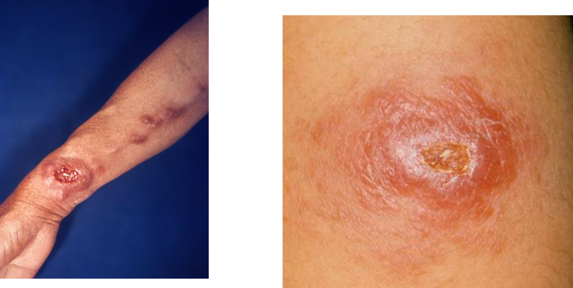 <ul><li><p>Lesions on exposed skin bc <span style="font-size: calc(var(--scale-factor)*26.30px)">sand fly mouthparts cannot</span><br><span style="font-size: calc(var(--scale-factor)*26.27px)">penetrate through clothing</span></p></li><li><p><span style="font-size: calc(var(--scale-factor)*26.27px)"><u>Starts as painless pink papule → a large nodule → painless ulceration with an indurated border</u></span></p></li><li><p><span style="font-size: calc(var(--scale-factor)*26.27px)">Gradual healing over months/years</span></p></li><li><p><span style="font-size: calc(var(--scale-factor)*26.27px)">Reactivation can develop during the subsequent year or later for mucosal leishmania (which is very destructive of nasal and other cartilage!)</span></p></li><li><p><span style="font-size: calc(var(--scale-factor)*26.27px)">Dx: Skin histology, culture or PCR (usually all 3)</span></p></li><li><p><span style="font-size: calc(var(--scale-factor)*26.27px)"> Tx: Azoles, pentavalent antimony, etc</span></p></li></ul><p></p>