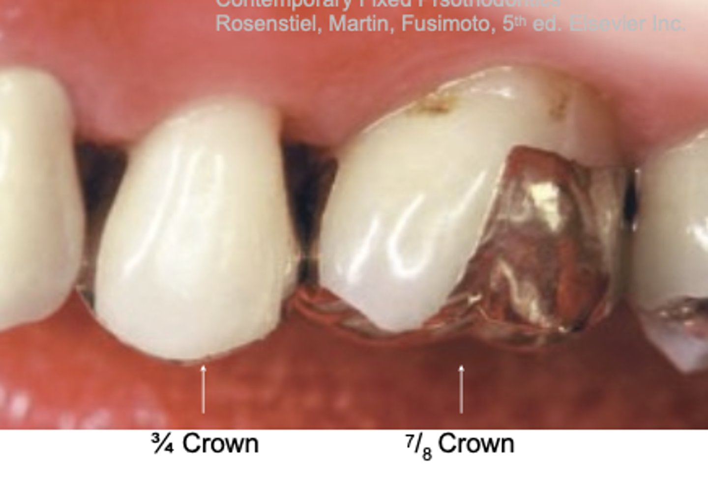 <p>What type of crowns are shown?</p>