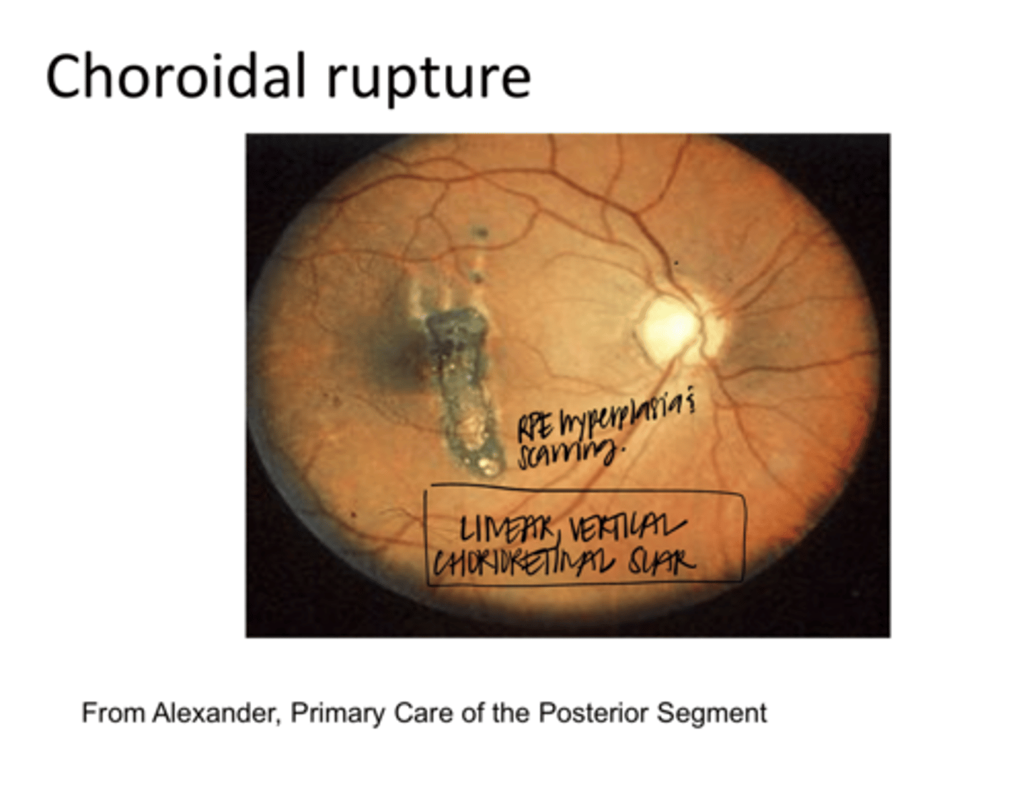 <p>Choroidal Rupture -- Scarring w/ RPE Hyperplasia (Pic)</p><p>**Linear, Vertical Chorioretinal Scar</p>