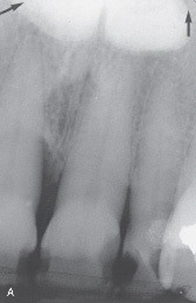 <p>This bony hard structure in the midline of the hard palate is genetic in origin and inherited in an autosomal dominant manner. The diagnosis is made through clinical appearance. Which condition is suspected?</p><p>A.Palatal cyst</p><p>B.Torus palatinus</p><p>C.Mixed tumor</p><p>D.Ranula</p>