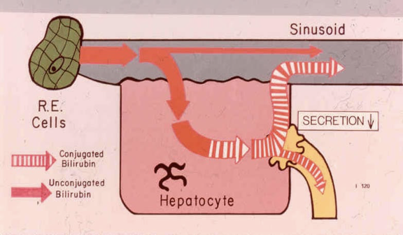 <p>There is a disease process in the liver so hepatocytes are stressed. The liver function is slowed down so there is a slower uptake which will lead to an increased unconjugated bili in the blood steam. The conjugated bili gets spit back into the blood steam</p>