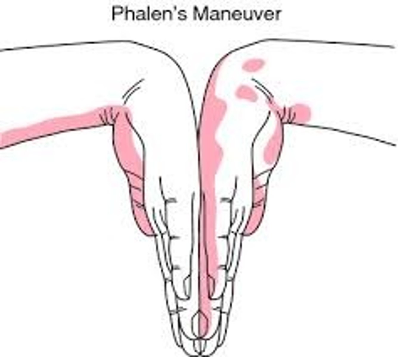 <p>phalen maneuver for carpal tunnel → pain = positive</p><p>tinel test is the other one → percussion over median nerve</p>