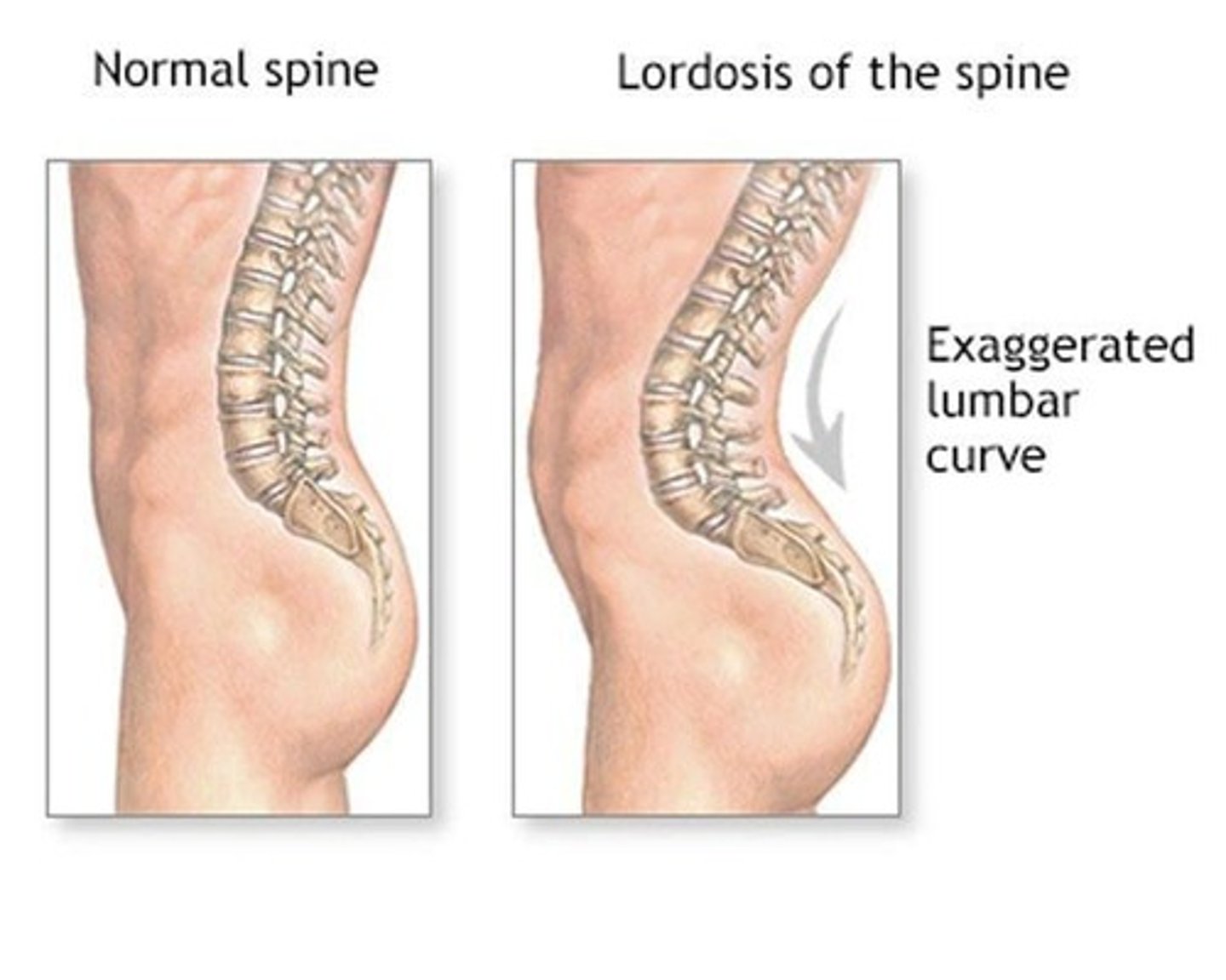 <p>Excess inward curve of the spine.</p>