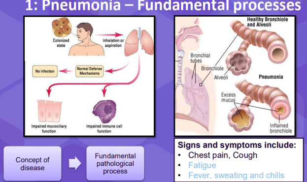 <p>&gt;Concept of disease = there’s an infection in the lung</p><p class="MsoNormal">&gt;Fundamental pathological process = you have to have inhalation of the pathogen e.g. bacteria normally its cleared by your defence mechanisms but for some reason it gets not your lung and affects the cells in the lung, impairing the cells that make mucus for instance and therefore breaking that barrier a little bit, or could cause extra mucus to be produced (image top right). When you get this sort of thing you can start to explain some of the symptoms.</p><p class="MsoNormal">&gt;Systemic pathophysiology = You have an issue with your lung, you impaired gas exchange which causes hypoxia, which then affects multiple tissues in your body, but then has an impact of your heart. This dysfunction then, (you can go through multiple strategies as shown below) <span>&nbsp;</span>can cause heart failure.</p>