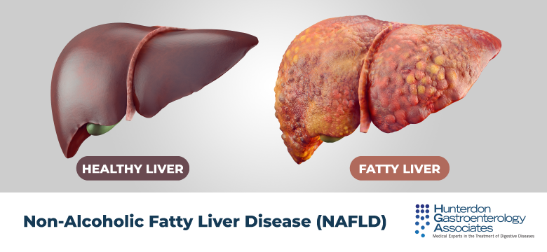 <p>It's a<strong> buildup of fat in the liver </strong>due to imbalance between fat made by the liver and fat used/exported.</p>