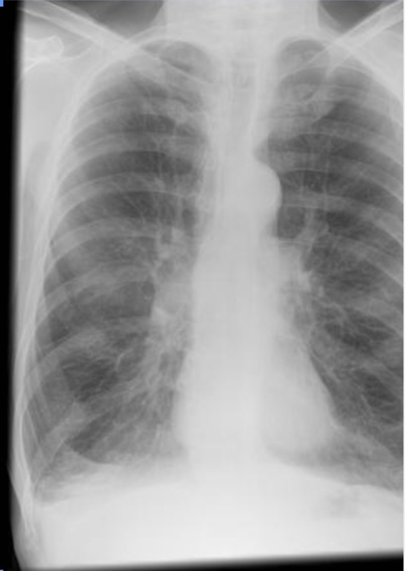 <p>This x-ray shows what deficit?&nbsp;</p><p>A. Ground-Glass Opacities</p><p class="p2">B. Flattened Diaphragm</p><p class="p1">C. Mediastinal Shift</p><p class="p1">D. Cardiomyopathy</p>