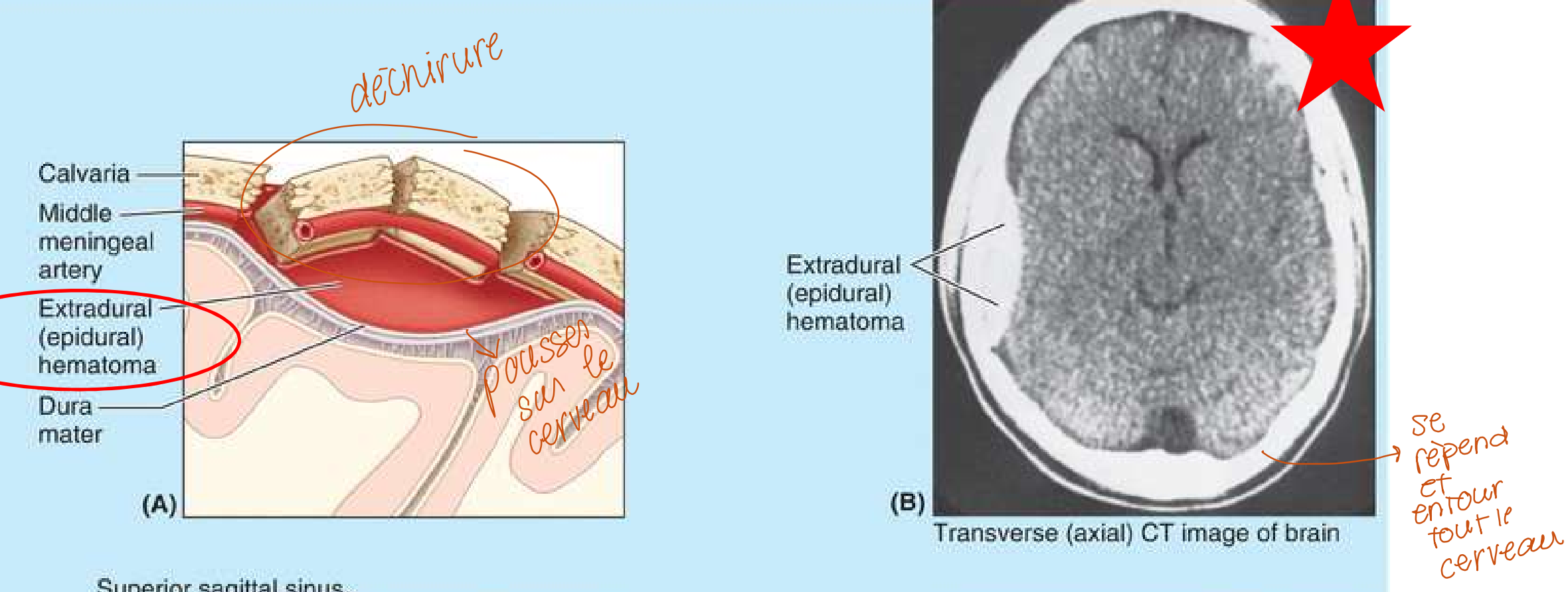 <p>Déchirure du crane et du vaisseau sanguin. Le sang vient pousser sur le cerveau. À l’extérieur de la mère dure </p>