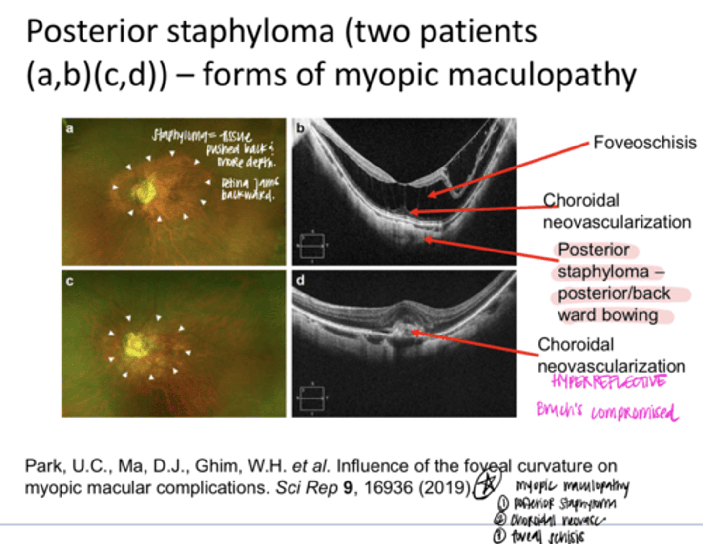 <p>EXAM QUESTION: What are the 3 components of myopic maculoapthy?</p>