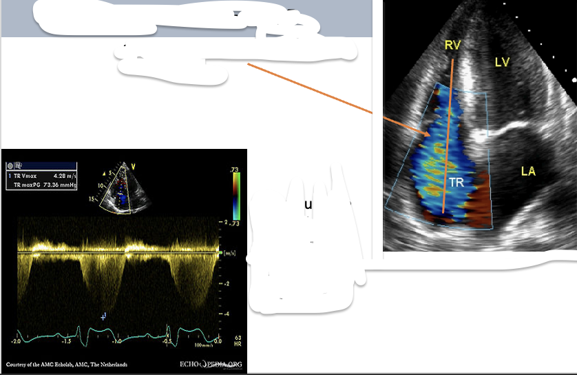 <p>How to obtain the RVSP/SPAP?</p>