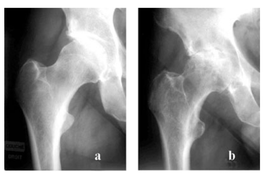 <p>= prolifération intra-articulaire d’un micro-organisme cultivable → urgence dia +++ (dégradation cartilagineuse rapide avec séquelles + risque de septie sévère </p><p></p><p>Diag : </p><ul><li><p>radio : pincement diffus de l’interligne articulaire avecérosion osseuses sous-chondrales, sans ostéophytes si abs de ttt  </p></li></ul><p></p>