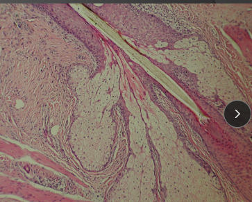 <p><span>Sebaceous Adenitis</span></p>