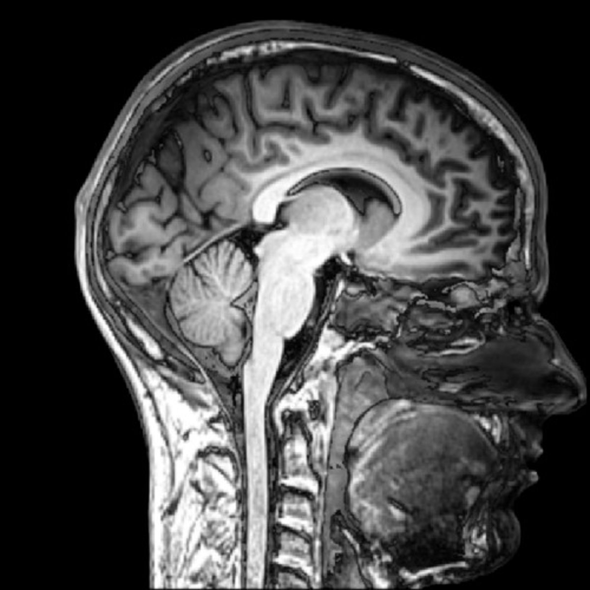 <p>a technique that uses magnetic fields and radio waves to produce computer-generated images that distinguish among different types of soft tissue; allows us to see structures within the brain</p>