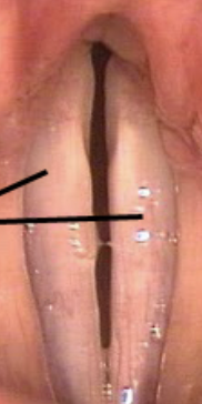 <p>What neurogenic voice disorder is this?</p>
