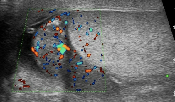 <p>Epididymitis</p>