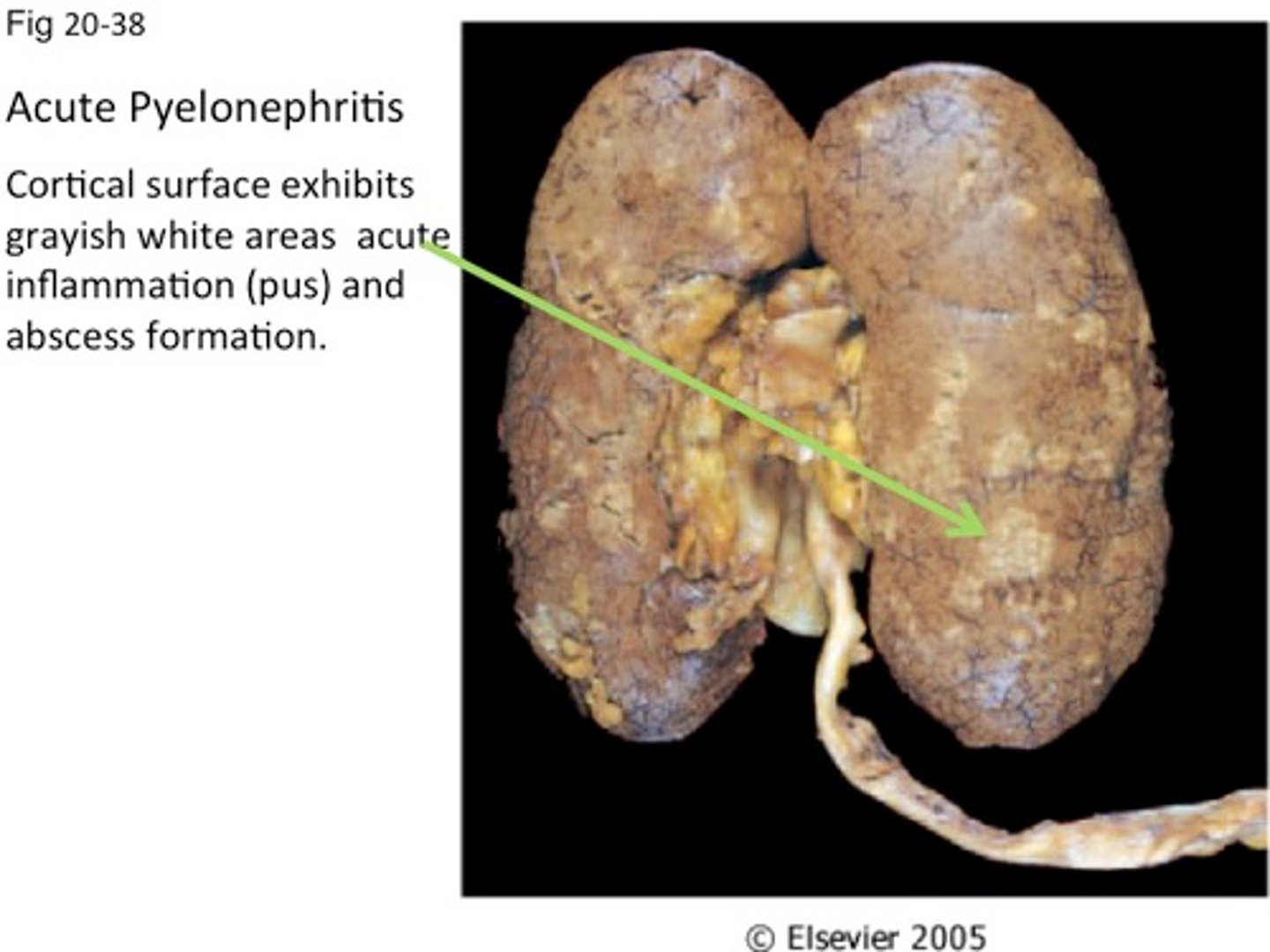<p>inflammation of the renal pelvis and the kidney</p>