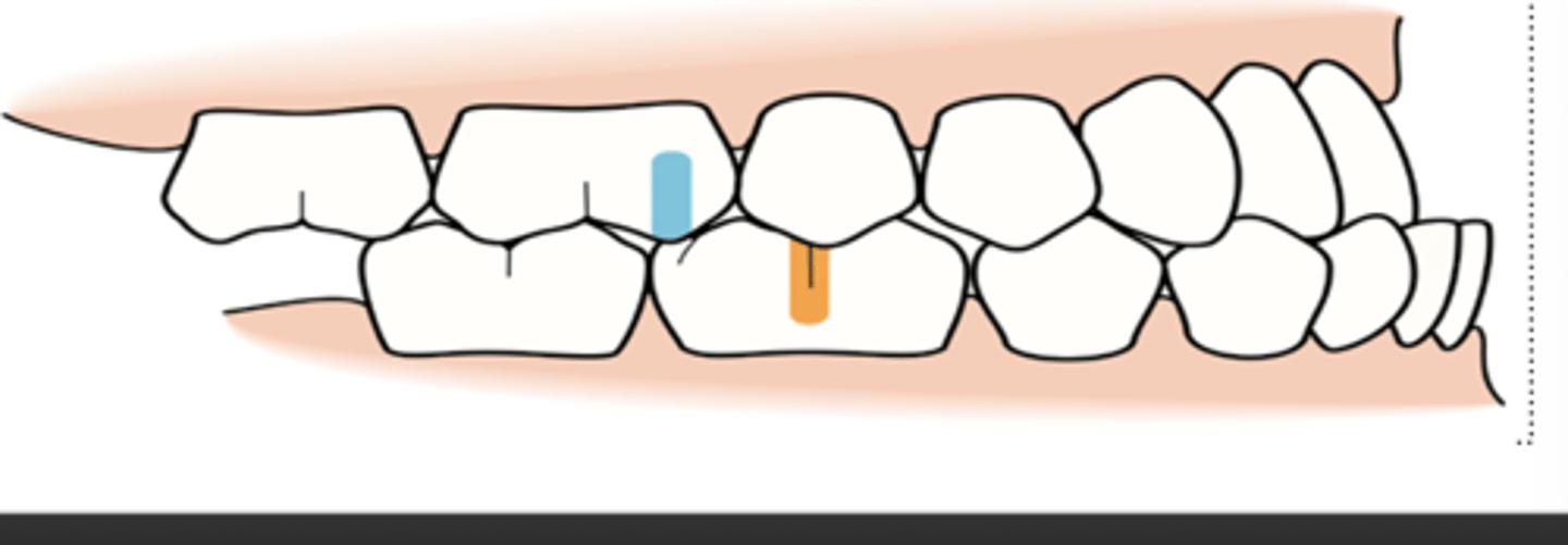 <p>underbite</p>