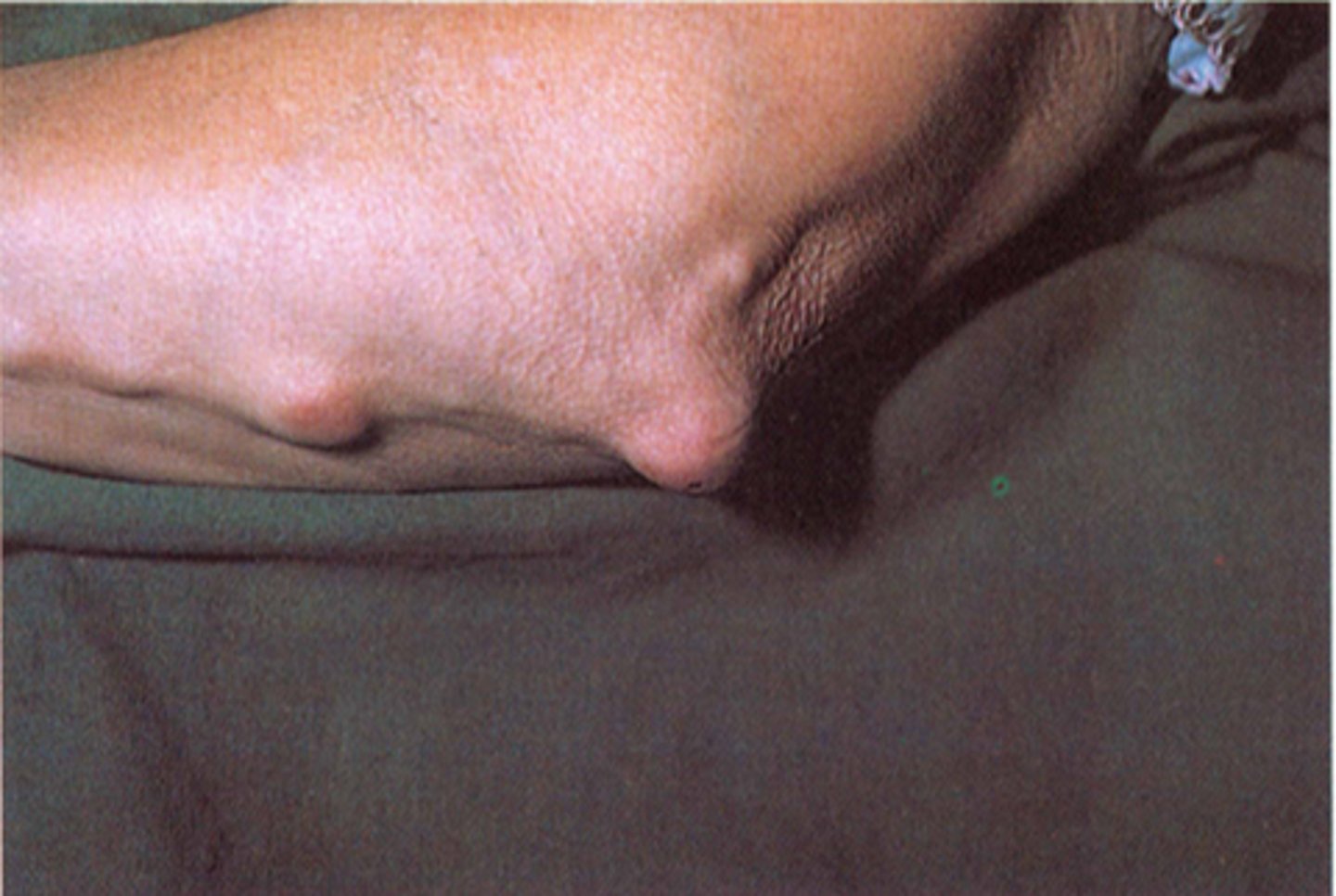 <p>1) nodules</p><p>2) RA</p>