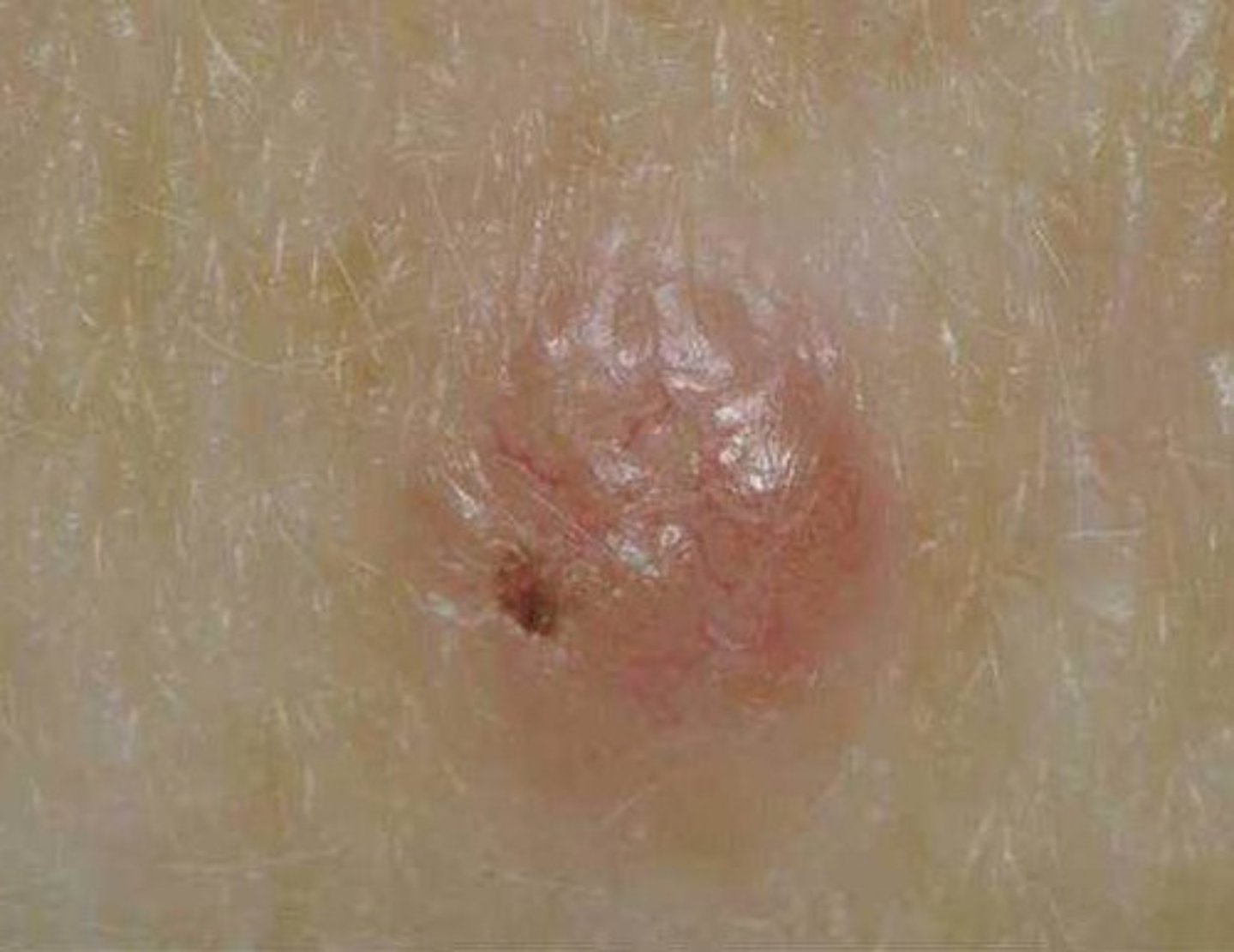 <p>-the least malignant and the most common skin cancer</p><p>-stratum basal cells proliferate and slowly invade dermis and hypodermis</p><p>-cured by surgical excision usually</p>