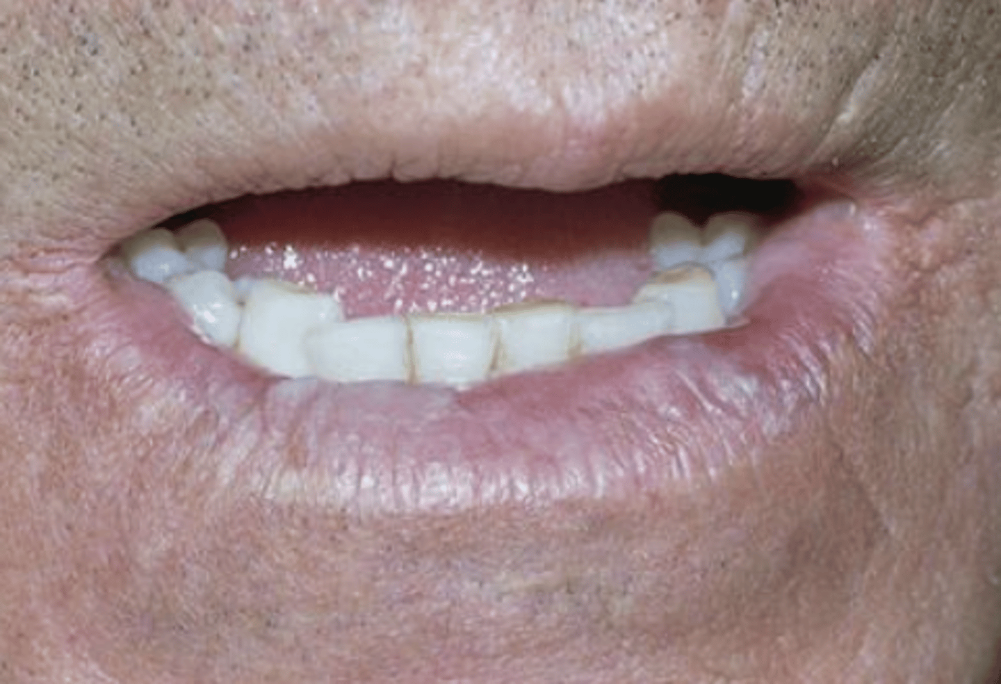 <p>Diffuse, irregular border of lower lip</p><p>Blotchy, smooth pale areas</p>