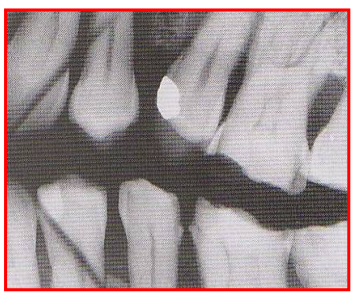 <ul><li><p>Thin radiolucent line appears on processed films </p><ul><li><p>Reason: crack in the film emulsion </p></li></ul></li><li><p>Fix: use gentle pressure on the films when bending to fit into oral cavity/XCP holder </p></li></ul><p></p>