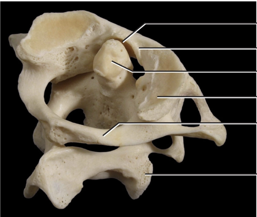 <p>C2 second cervical vertebra know as Axis , these is a structure in the middle named “dens,” meaning tooth</p><p>“dens” allocates with anterior arch that forms a rotational movement called  “no motion,” giving the name “axis” </p>