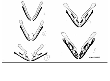 <p>-in stage 2: see beginning appearance of additional piece of bone- forms in a V shape, where teeth are going to develop</p><p>-between stages 2 and 3: shape of lower jaw changes A LOT, secondary palate forms and face gets wider and shorter in AP direction</p><p>-stages 3 and 4: developing bone of mandible (Meckel’s cartilage) gets incorporated in a zig-zag fashion; area of Meckel’s cartilage that will contribute to the mandible in endochondral ossification</p><p>-stage 5: developing teeth</p>