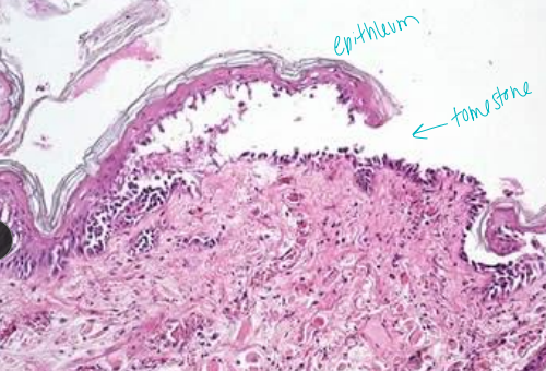 <ul><li><p> <strong><u>Vesiculobullous, erosive to ulcerative disorder</u></strong></p><ul><li><p>Deeper then PF</p></li></ul></li><li><p><span style="color: rgb(136, 136, 136);"><strong>Et: </strong></span><span style="color: red;"><strong><u>Suprabasliar vesicles and clefts, DSG 3</u></strong></span></p></li><li><p><span style="color: rgb(136, 136, 136);"><strong>Cs:</strong> </span>erosions, ulcers, pain, systemic dx</p><ul><li><p><strong><u>Oral/mucocutaneous</u></strong>, <strong>axillae, groin (friction)</strong>, clawbeds</p></li><li><p><u>Secondary bacterial pyoderma and lymphadenopathy may be present</u></p></li></ul></li><li><p><span style="color: rgb(136, 136, 136);"><strong>Dt:</strong></span><strong> </strong>smears, biopsy, immunotesting</p></li><li><p><span style="color: rgb(136, 136, 136);"><strong>Tx:</strong></span><strong> </strong>pred + azathioprine (D), chlorambucil (C)</p><ul><li><p><strong>Poor prognosis w/o Tx</strong></p></li></ul></li></ul><p></p>