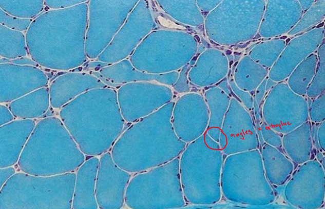 <p>with damage of the innervating axon, the muscle fibers that undergo atrophy will be in groups </p>