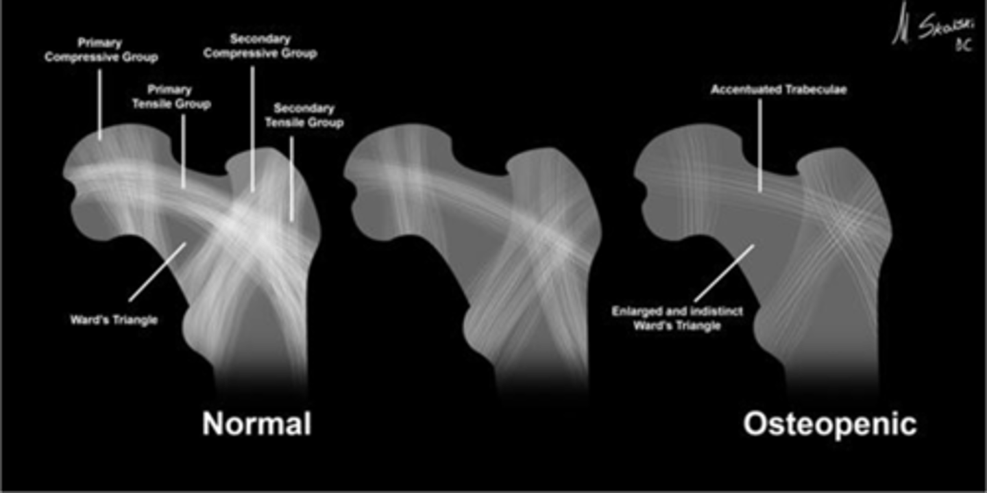 <p>Wards triangle becomes enlarged as bone density reduces, signifying _____</p>
